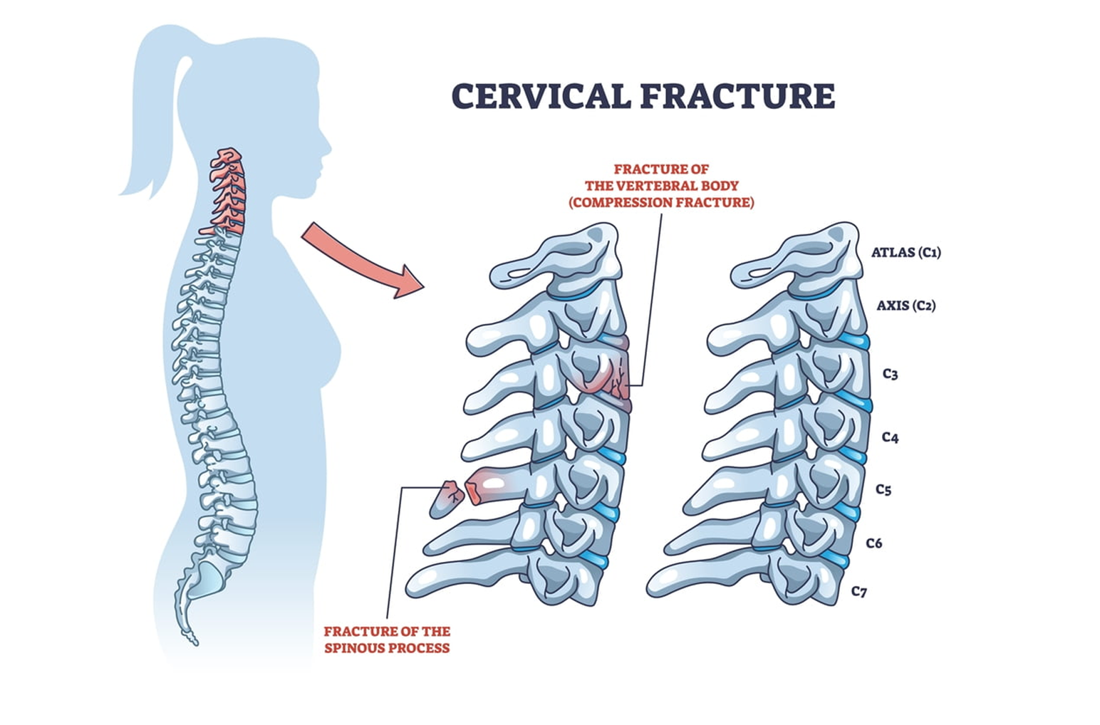 Physical therapy session for spine recovery