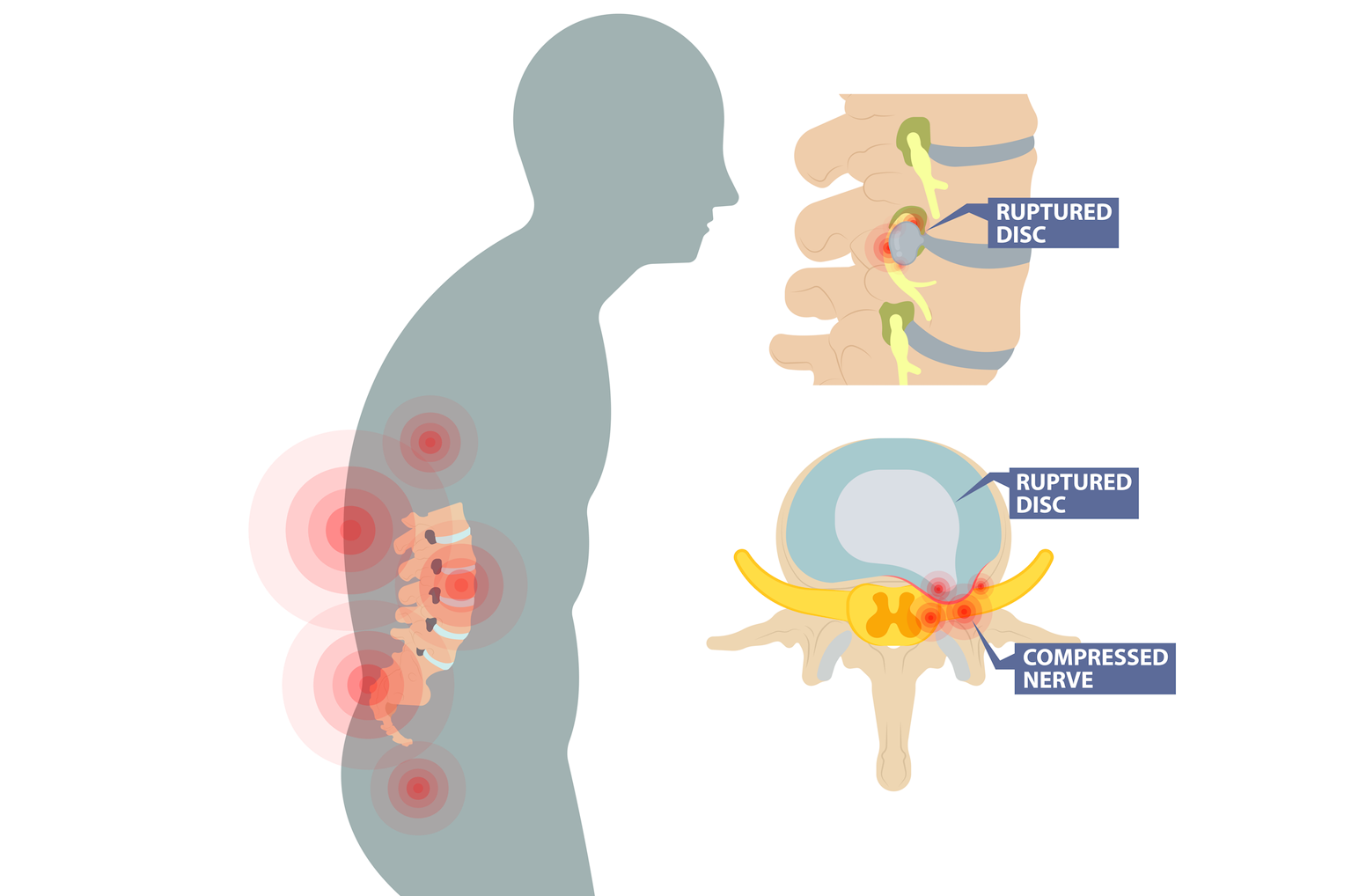 Spinal Cord Injury Diagram