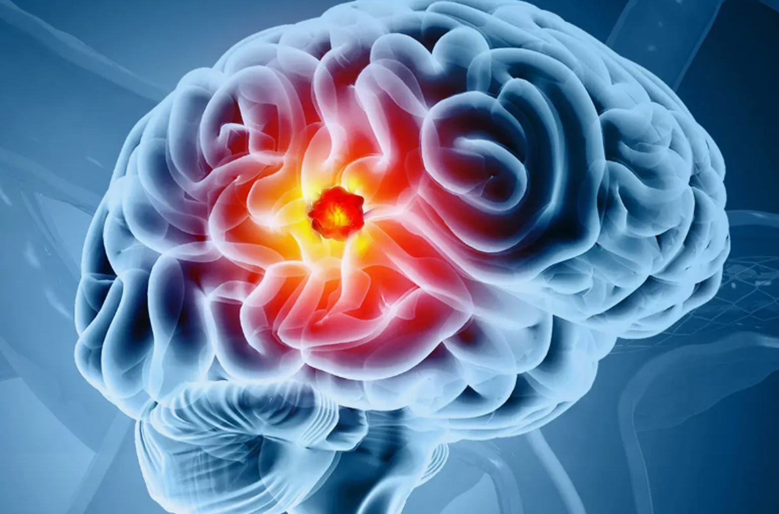 Brain mapping for seizure focus
