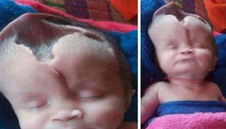 pregnancy के दौरान की ऐसी गलती, बच्ची की खोपड़ी में हो गया कुछ ऐसा pregnancy के दौरान की ऐसी गलती, बच्ची की खोपड़ी में हो गया कुछ ऐसा