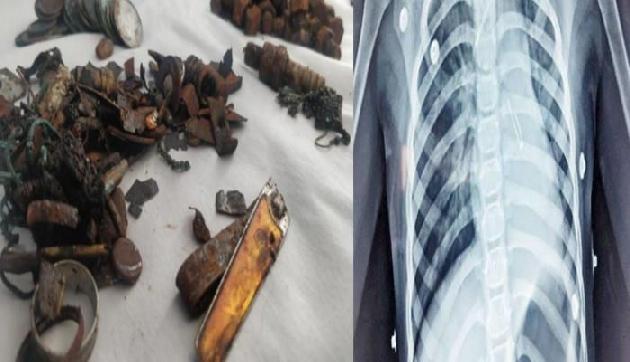 लोहा खाने का अजीब शौक, Doctor ने पेट से निकालीं कीलें समेत 452 चीजें लोहा खाने का अजीब शौक, Doctor ने पेट से निकालीं कीलें समेत 452 चीजें