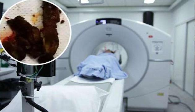 इस शख्स ने 20 साल पहले निगली थी ऐसी चीज, सीटी स्कैन ने Doctars के भी उड़ाए होश इस शख्स ने 20 साल पहले निगली थी ऐसी चीज, सीटी स्कैन ने Doctars के भी उड़ाए होश