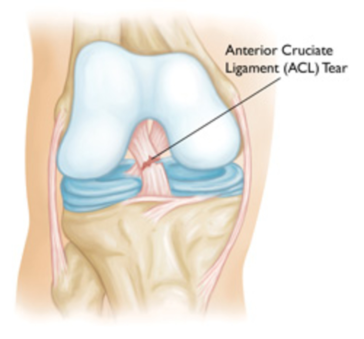acl tear.jpg acl tear.jpg