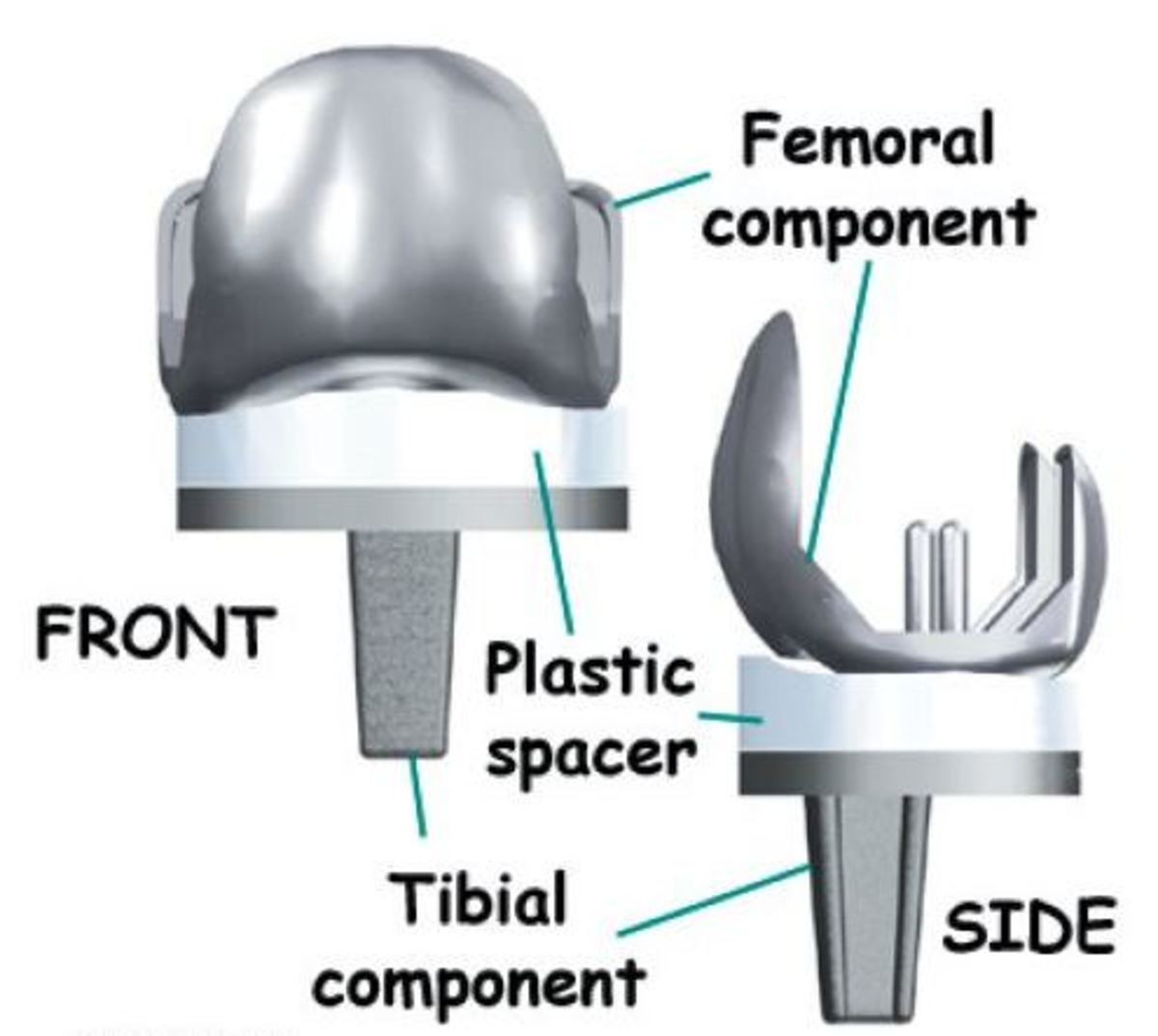 PARTS OF TOTAL KNEE REPLACEMENT