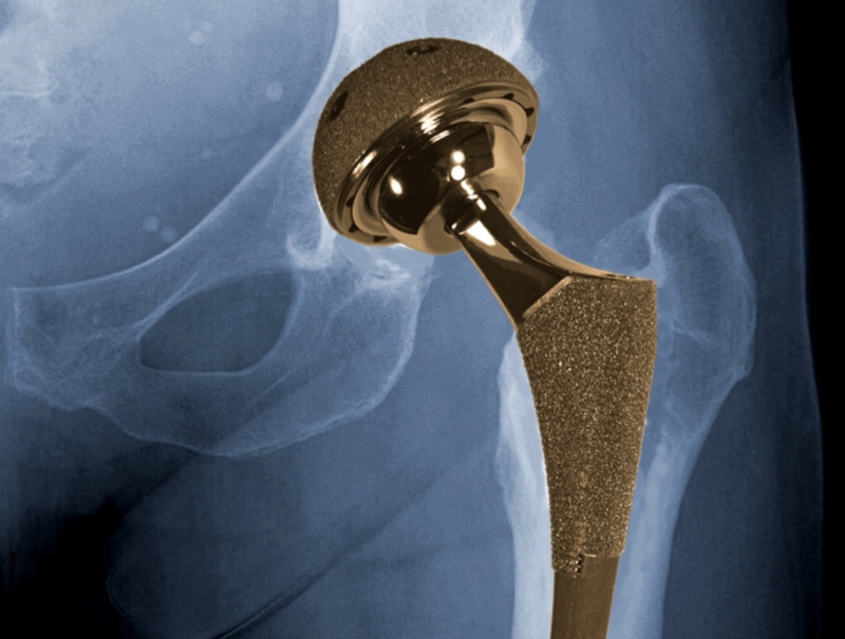 Hip-Implant.jpg Hip-Implant.jpg