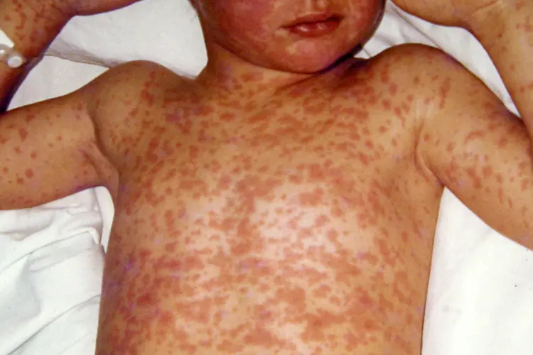 What Is Measles?