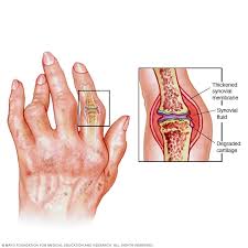 What is Rheumatoid Arthritis?