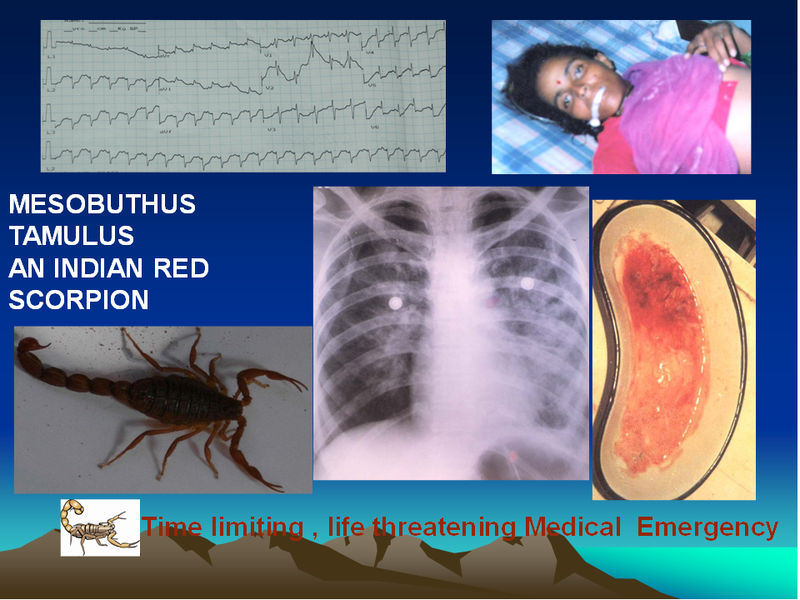 scorpion sting symptoms duration