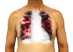 tuberculosis