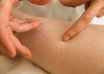 Acupuncture