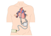 left-ventricular assist device