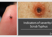 scrub typhus