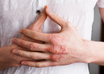 psoriasis