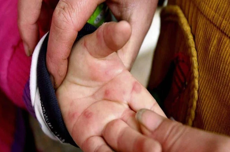 Government issued advisory on Tomato Flu