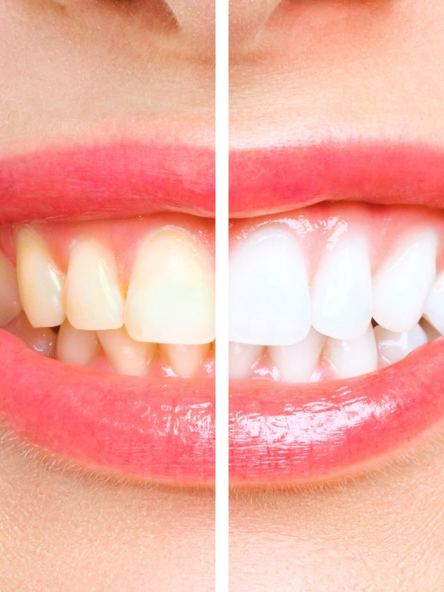 पीले दांतों से हैं परेशान? अपनाएं ये देसी नुस्खा देखें चमत्कार