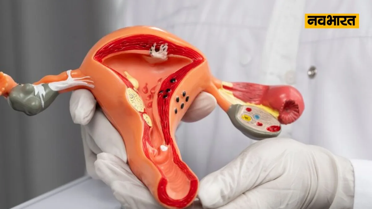 Cervical Cancer