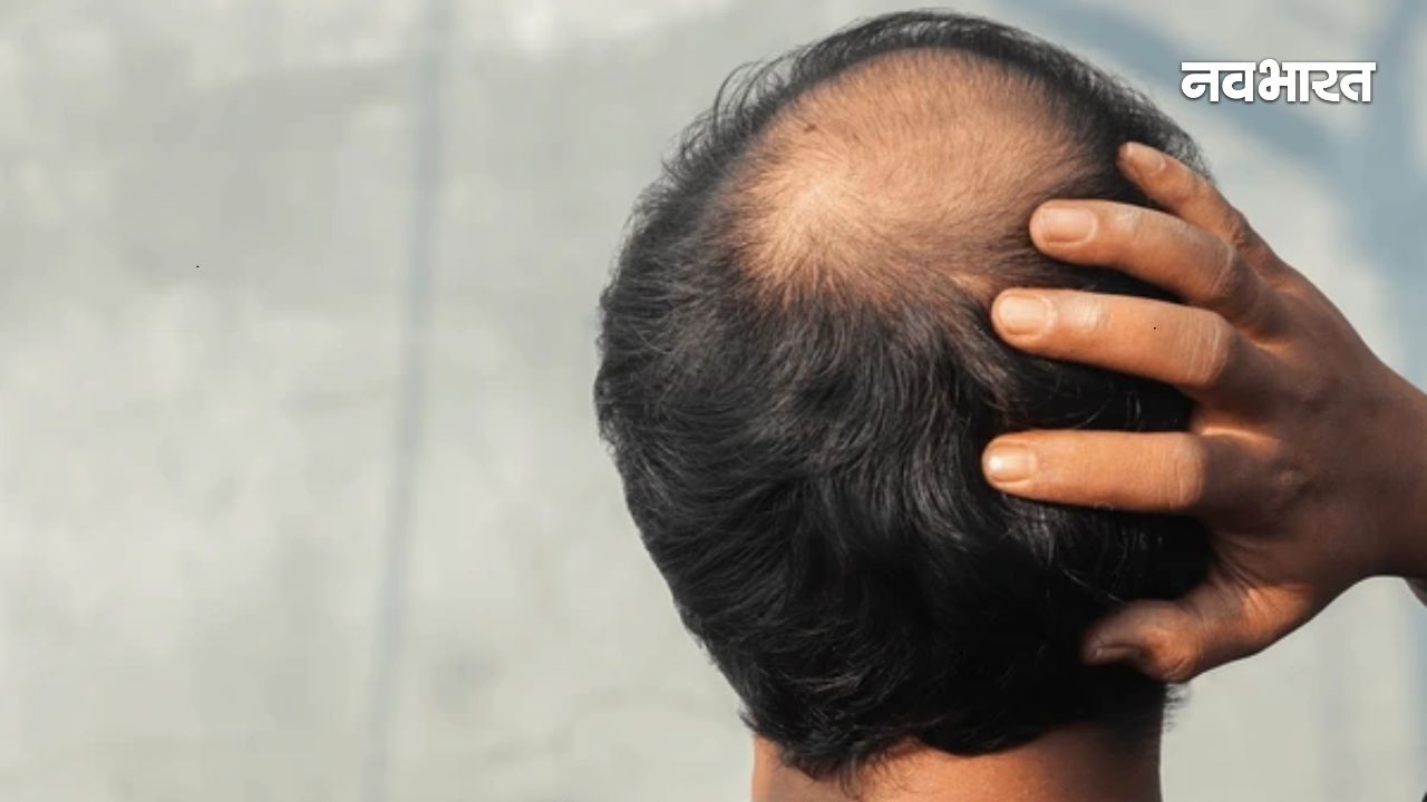 शादी के बाद पता चला पति गंजा है, रोते-रोते पत्नी पहुंच गई थाने, 5 के खिलाफ दर्ज कराई FIR