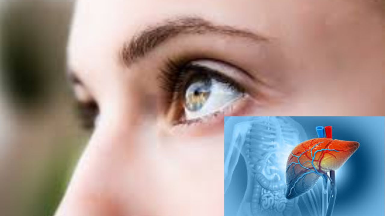 Fatty Liver Symptoms: మీ ముఖంపై ఈ 5 సాంకేతాలు గమనించారా..? ఫ్యాటీ లివర్ లక్షణాలు