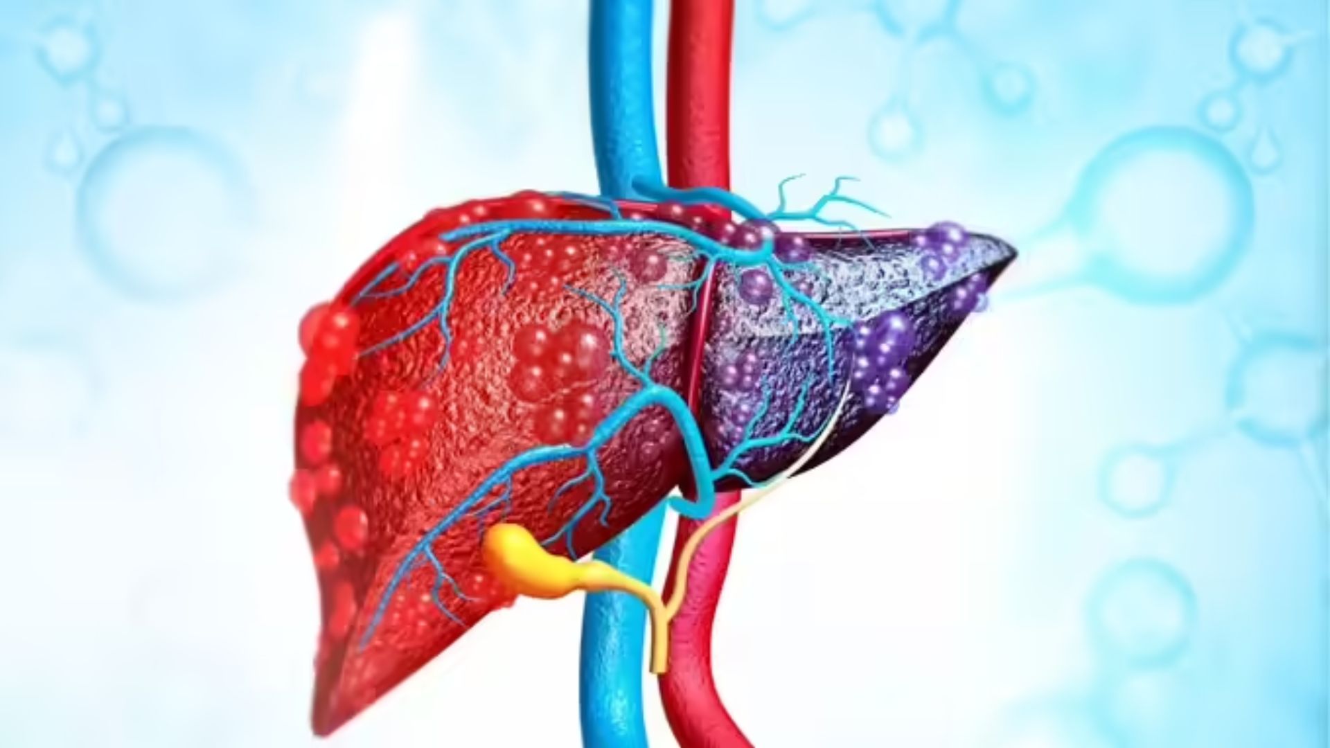 Fatty Liver: అల్లం, పసుపుతో ఫ్యాటీ లివర్ సమస్యకు చెక్..!