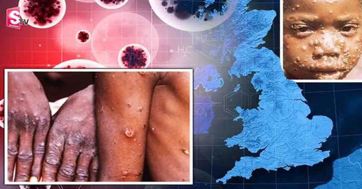 monkey pox