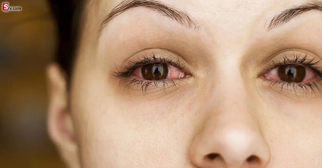 eye-conjunctivitis