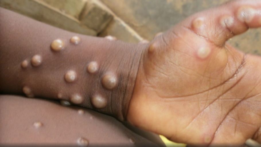 A UAE returnee was kept in isolation as he showed symptoms similar to monkeypox. 