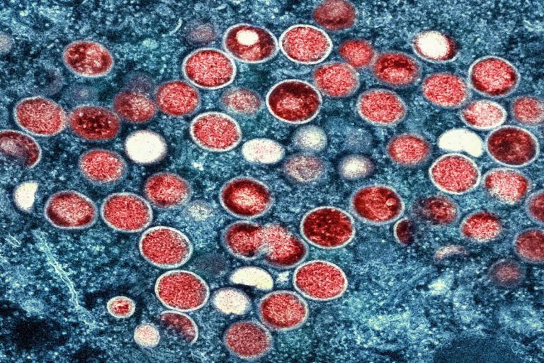 One case of Mpox or Monkeypox reported in Kerala
