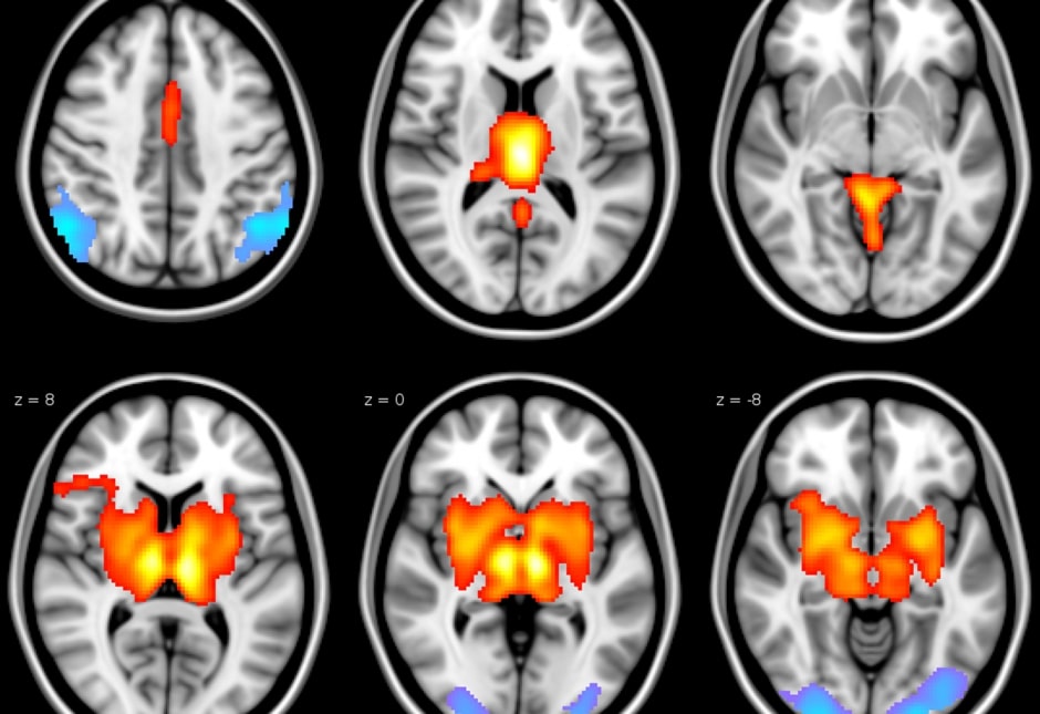 Epilepsy-scan Epilepsy-scan