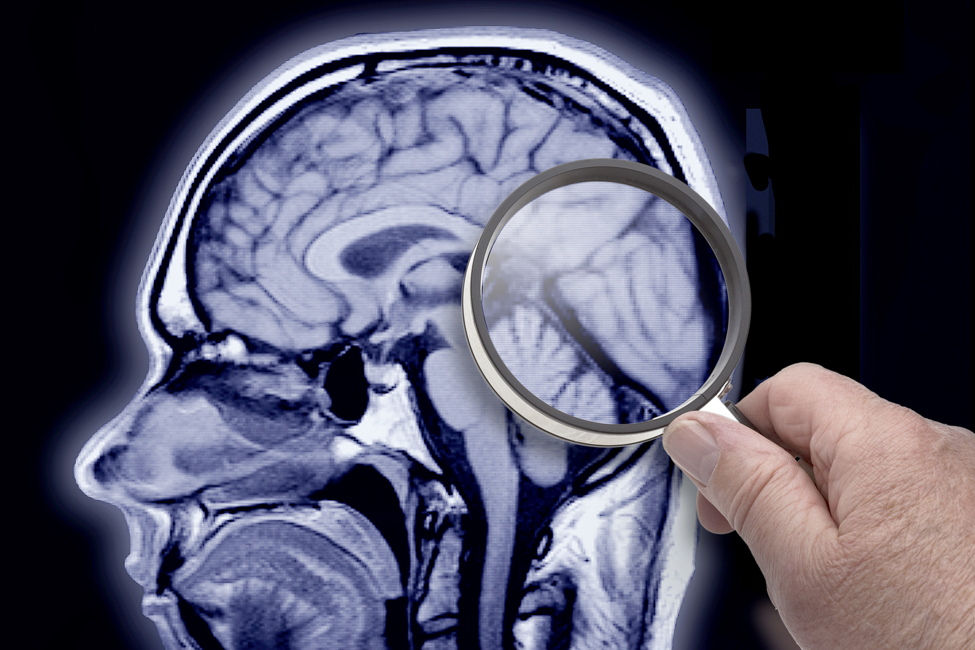 alzheimers Alzheimer's can be prevented if you start exercising your brain nerves much earlier say docs