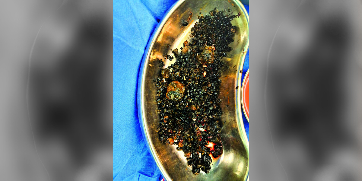 1000 stones from patient