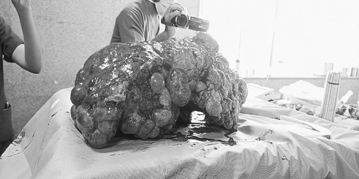 Hyderabad 12kg liver removed