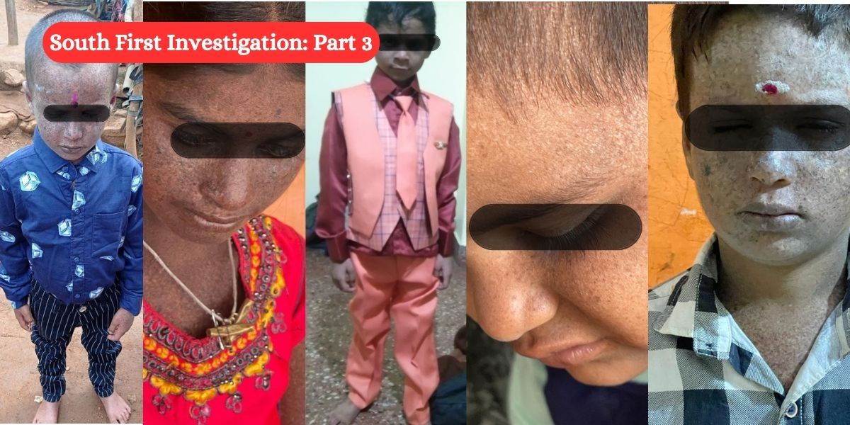 Images of the children affected. Xeroderma Pigmentosum: Ball now in government’s court, but it has miles to go to save children from premature death