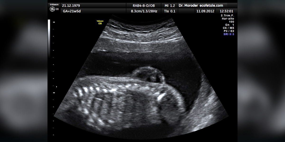 Radiologist Myelomeningocele Myelomeningocele in ultrasonography. (Wikimedia Commons)