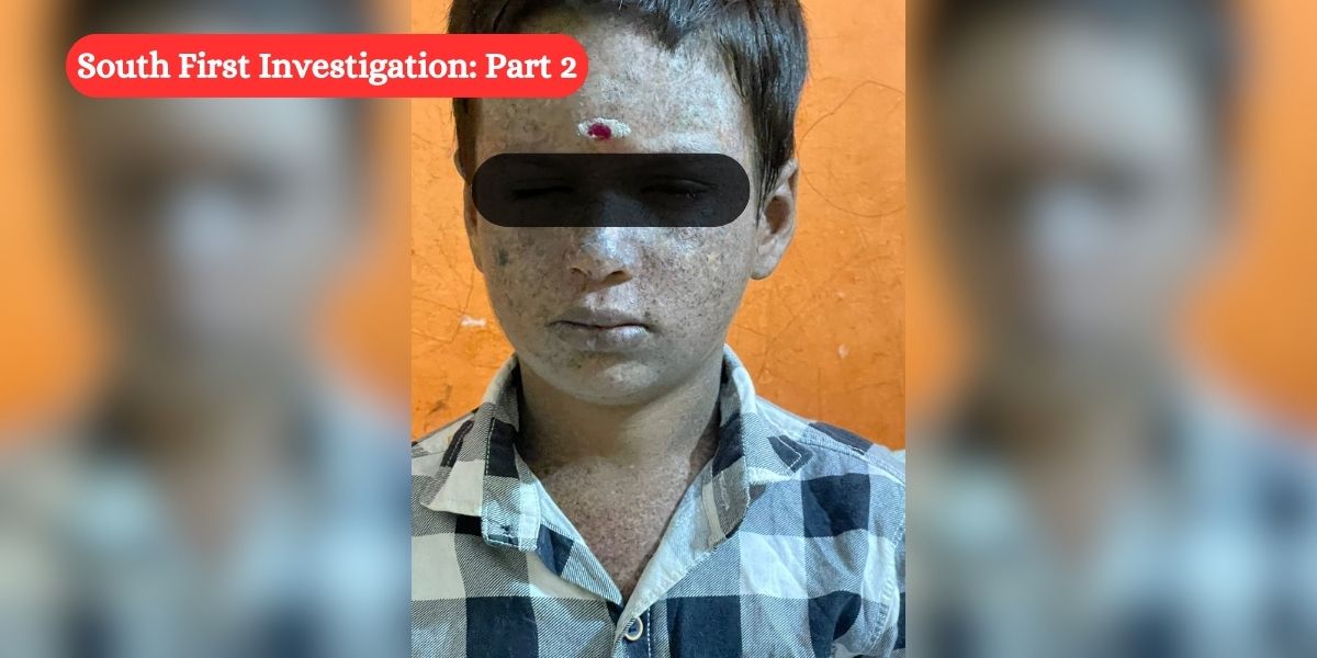 Seven year old Naveen who is currently in Bengaluru loves to read and write. (Chetana Belagere/South First) Xeroderma Pigmentosum: Parents helpless, doctors baffled as authorities remain blind to child-killing ‘chukki kayle’