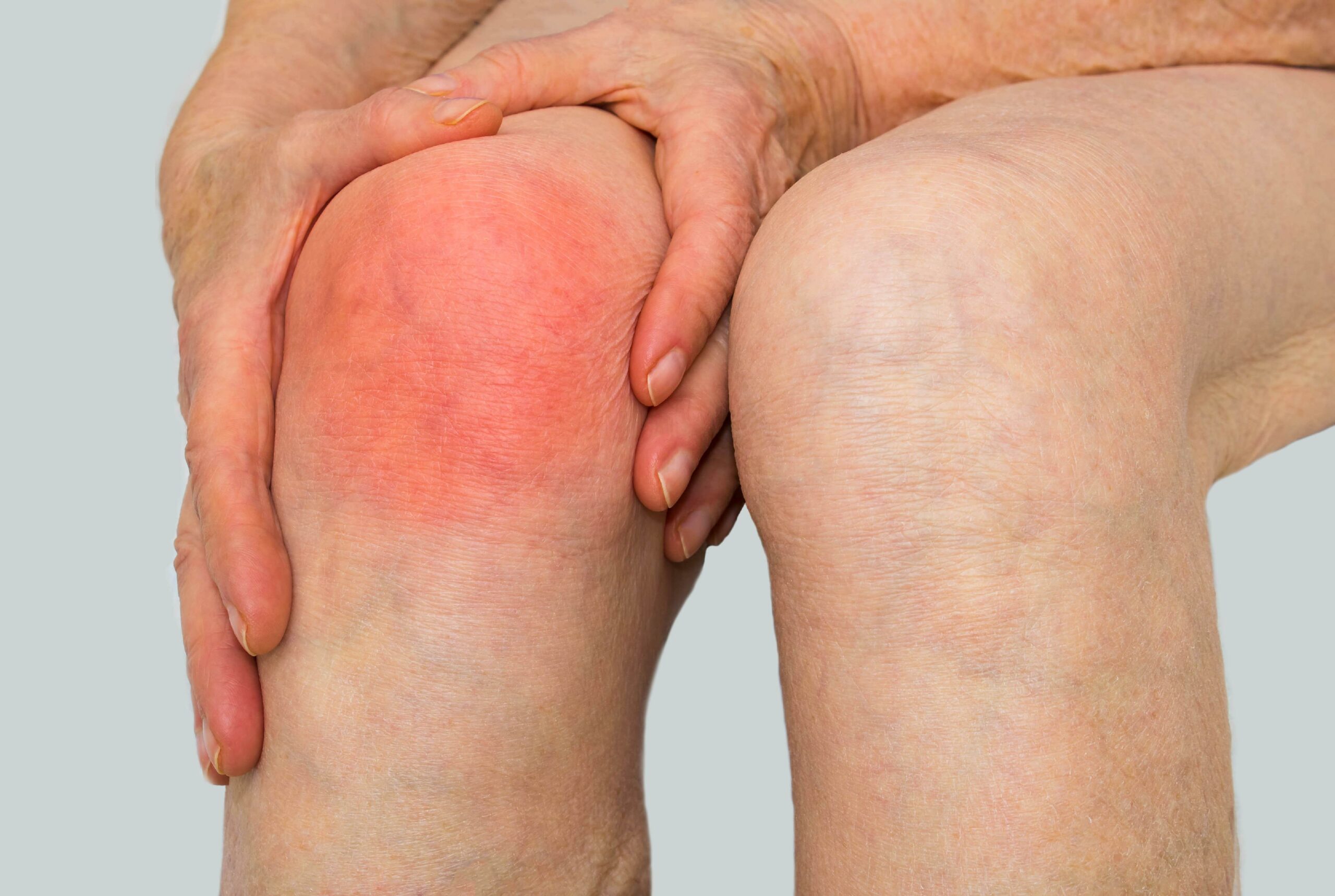 Symptoms of knee joint infection. (MedlinePlus)