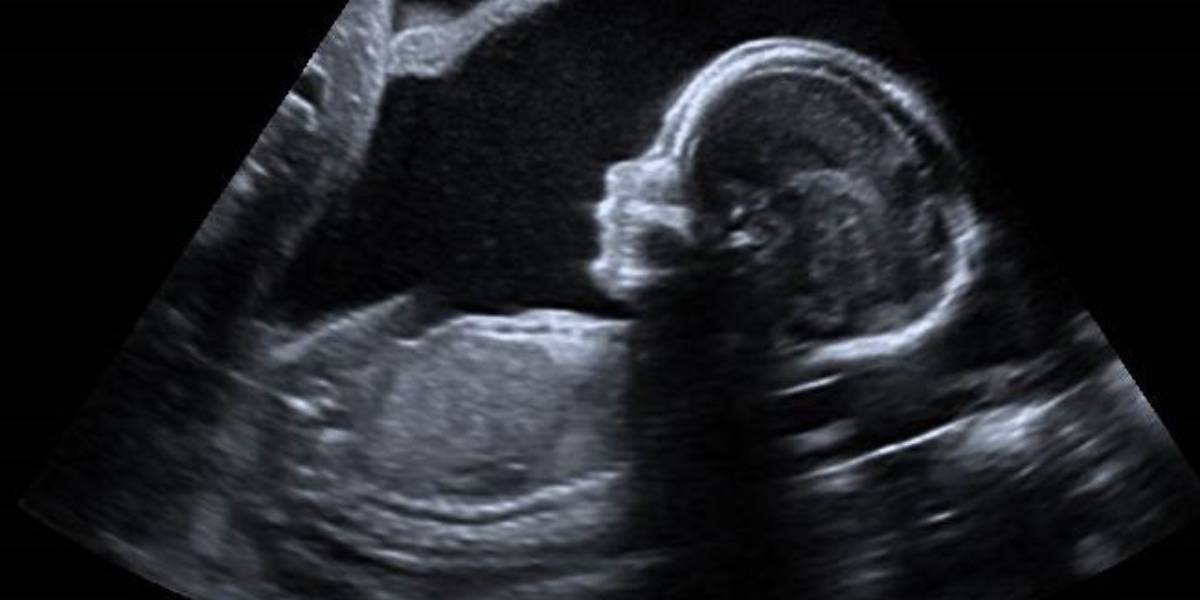 foetal anomalies kerala hospital Kerala hospital ordered to cough up ₹50 lakh for failing to detect foetal anomalies during pregnancy