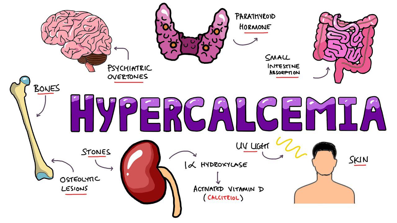 WhatsApp Image 2023-10-23 at 20.45.03 Hypercalcemia can cause a number of symptoms that affect various systems. (Rhesus Medicine/Supplied)