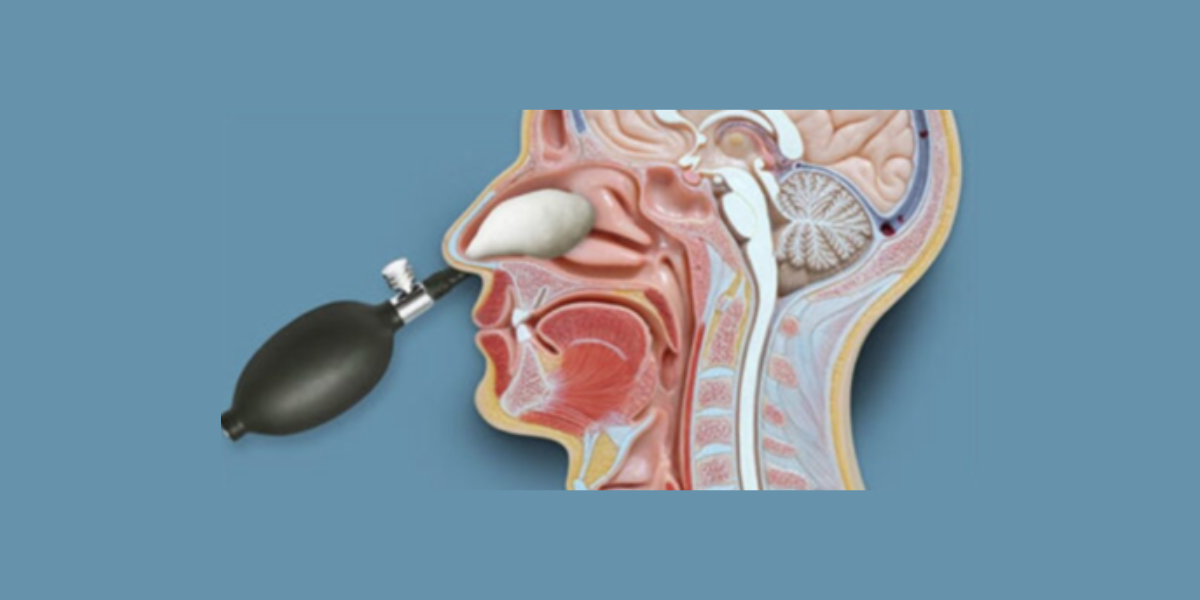 Nasocranial balloon release. (Rehab Guru)