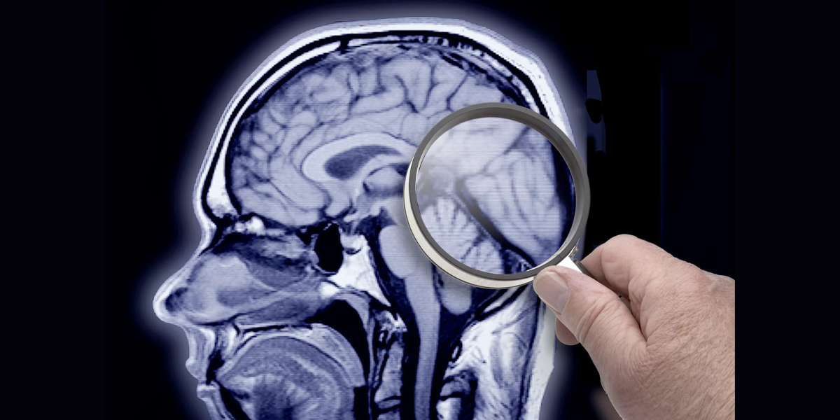 Alzheimer’s Alzheimer's study: In this research, 94 elderly cognitively unimpaired individuals were enrolled at an average age of 85 and followed for 11 years or until their passing.