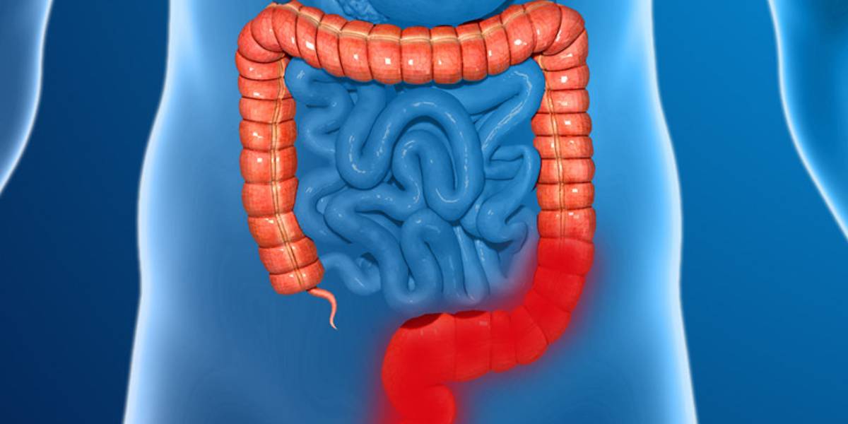 Inflammatory Bowel Disease What is Inflammatory Bowel Disease? 5.4% of Telangana’s population suffers from this disease
