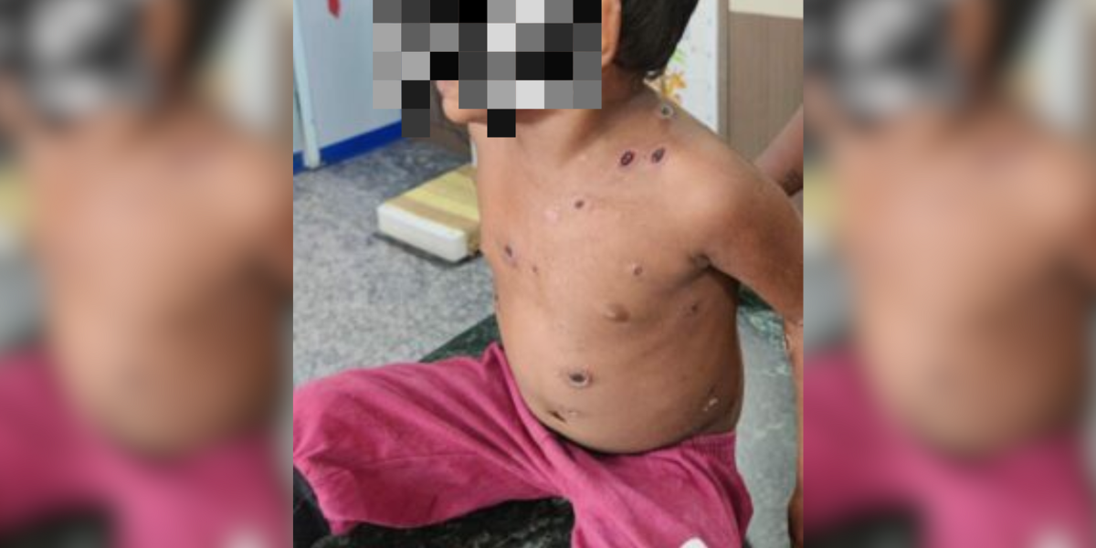 Small child infected with chicken pox. (Supplied)