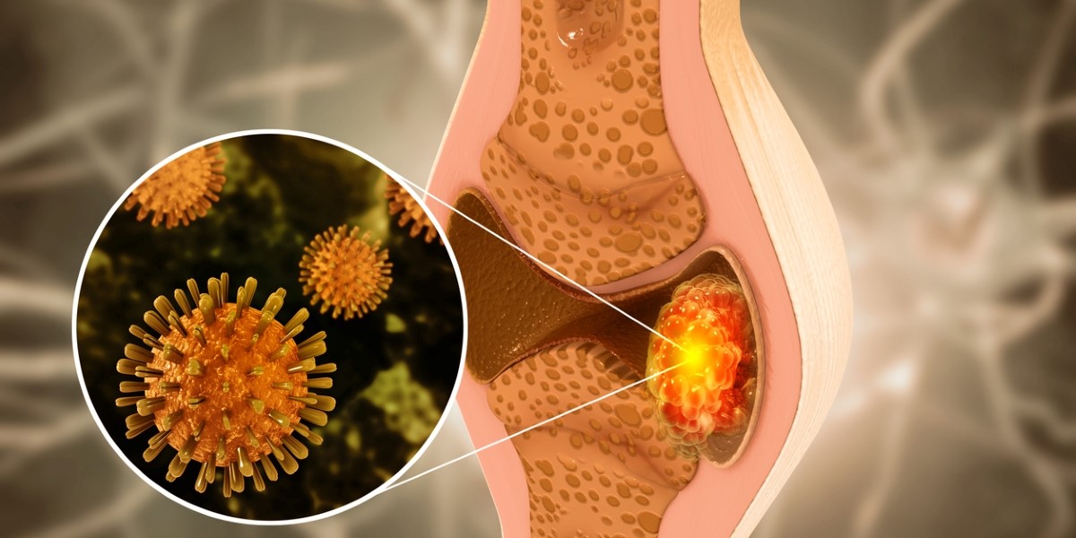 Bone cancer