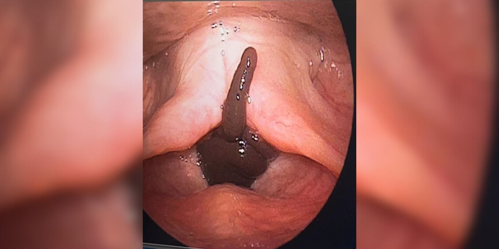 Leech The live leech inside the woman's larynx.