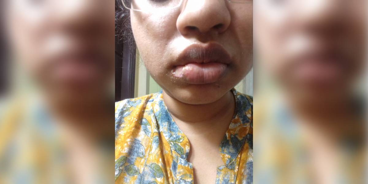 FMS International Dental Clinic A portion of the woman's lip was alleged burnt off during a dental procedure. (X/sowmya_sangam)