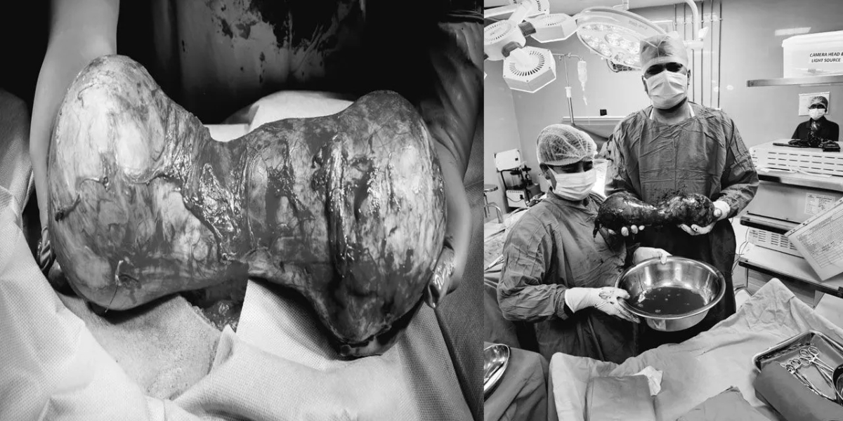 Hyderabad testis tumour Hyderabad hospital successfully removes rare, giant dumbbell-shaped testis tumour from 39-year-old man