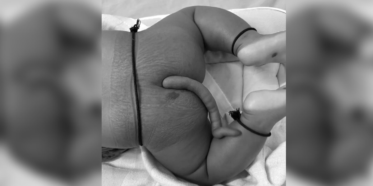 remove a human tail from a three month old infant Doctors at AIIMS Bibinagar successfully removed human tail from an infant