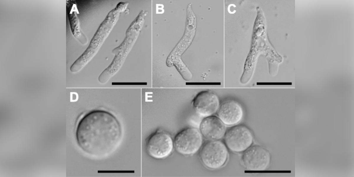 Amoebic Meningoencephalitis (PAM) and the puzzling presence of Vermamoeba vermiformis Amoebic Meningoencephalitis (PAM) and Vermamoeba vermiformis