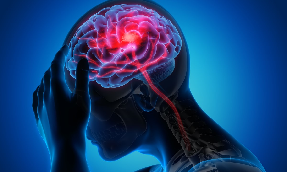 Brain stroke. Representative Image. (iStock) Brain stroke.