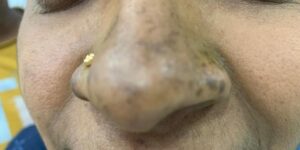 Blackening of nose is in chikungunya infected people in India
