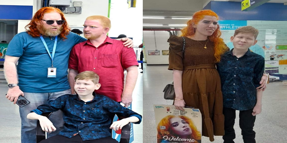 albinism Intercourse with people with albinism to cure AIDS? Kochi Metro chugs in to bust myths